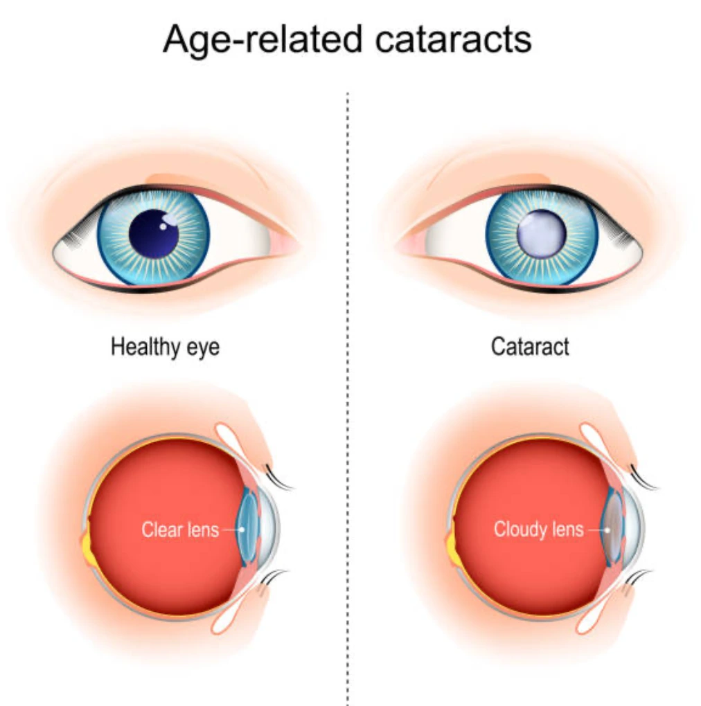 Chirurgie de la cataracte