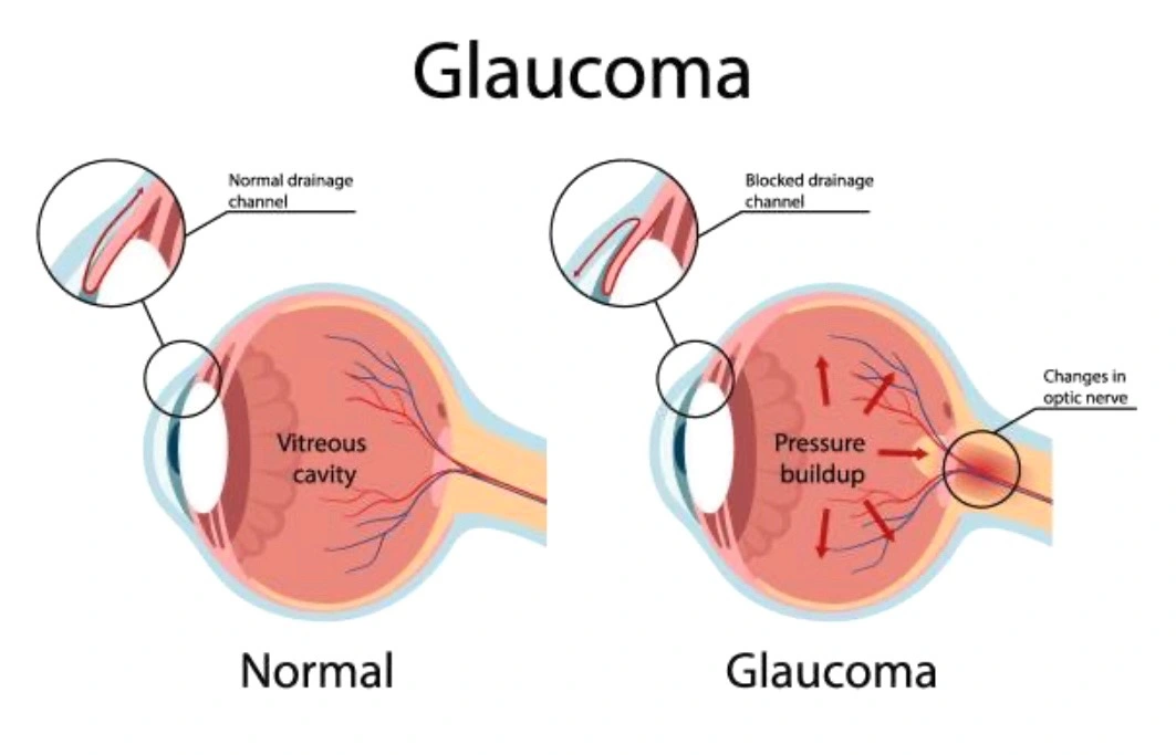 Glaucome